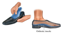 An Orthotics Guide – What are Custom 
